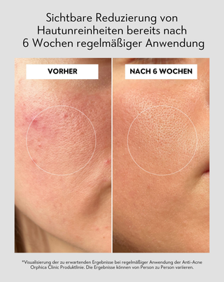 Anti-Akne-Tagescreme mit Salicyl- und Azelainsäure gegen Hautunreinheiten Anti-Acne Orphica Clinic 50 ml - 5