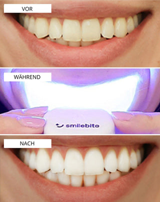 Aufhellungs-Kit mit LED-Lampe und Light & Bright Smilebite Bleaching-Gel