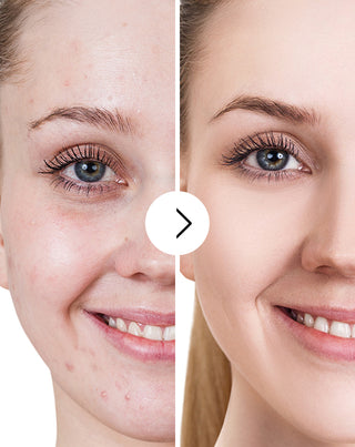 Tabletten gegen Akne, Pickel und Hautunreinheiten mit Zink, Vitamin C, E und B2 Derminax_5 - 5