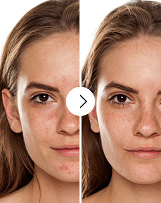 Tabletten gegen Akne, Pickel und Hautunreinheiten mit Zink, Vitamin C, E und B2 Derminax - 2