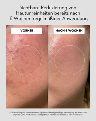 Gesichtstoner mit Niacinamid und Azelainsäure Anti-Acne Orphica Clinic 200 ml - 6
