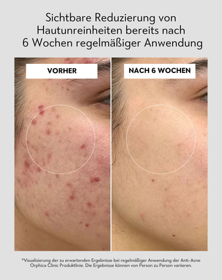 Gesichtspeeling mit Niacinamid, Panthenol, BHA und Mikrogranulaten Anti-Acne Orphica Clinic 100 ml - 5